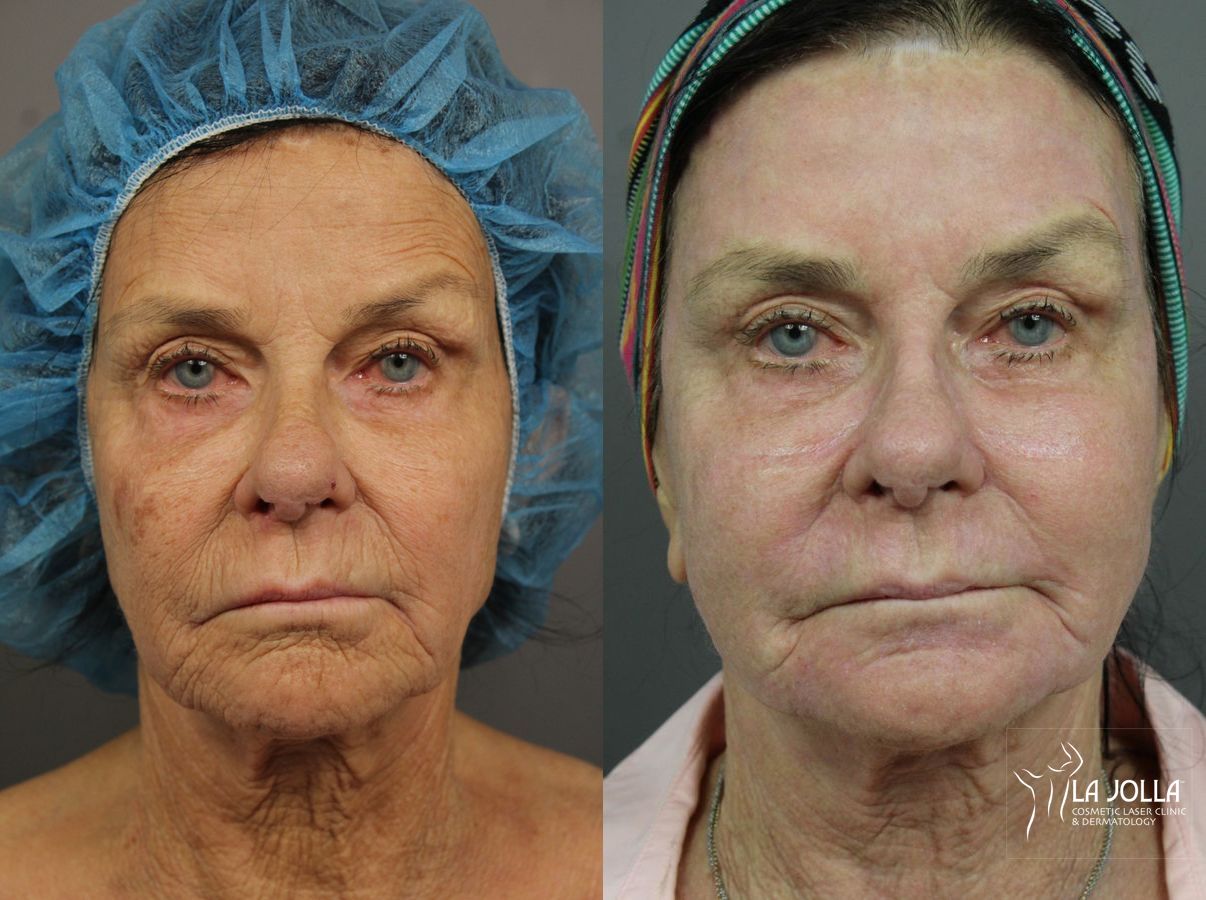 Before and after Ablative Laser Treatment case 36263