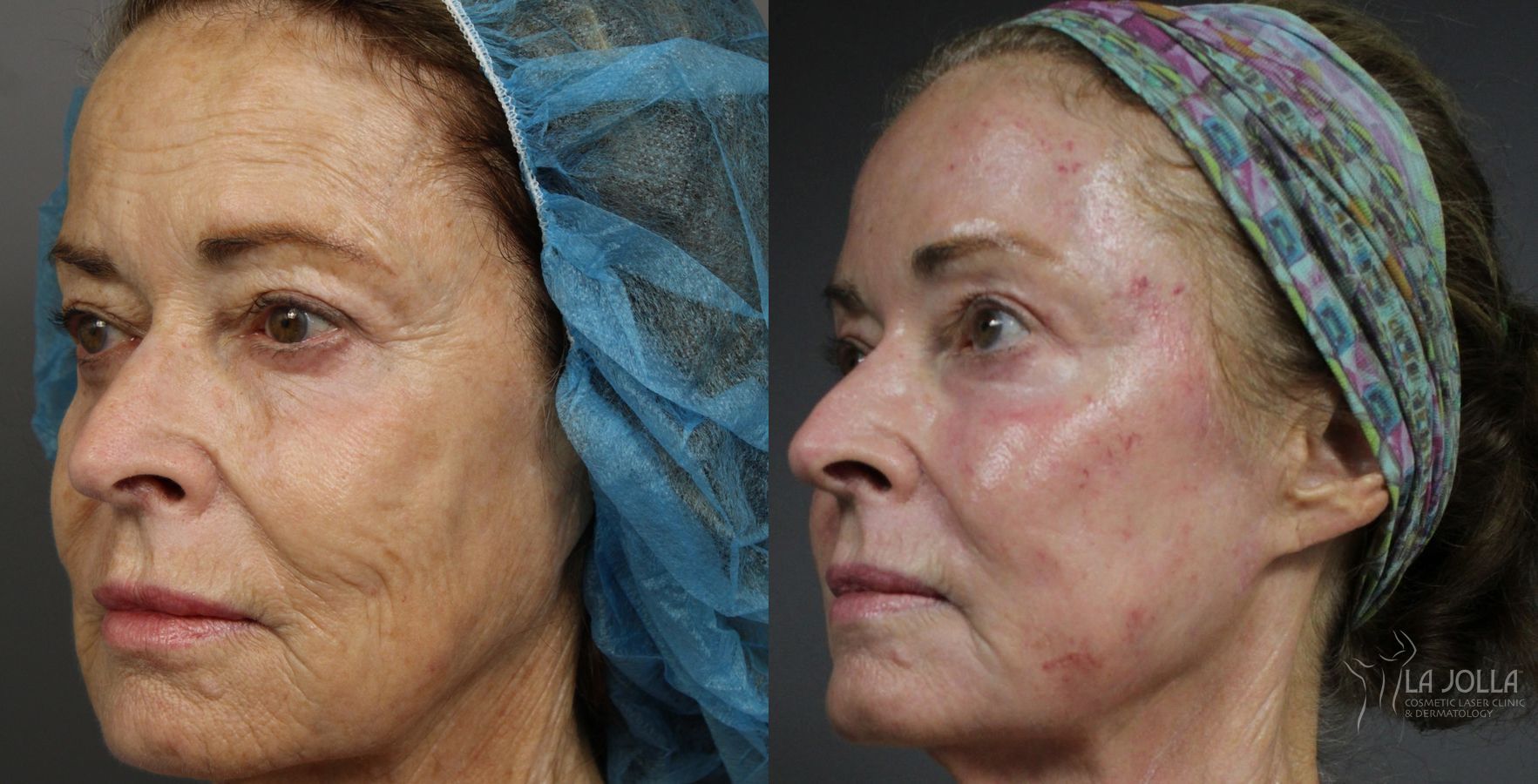 Before and after Ablative Laser Treatment case 36223 - Angle 3