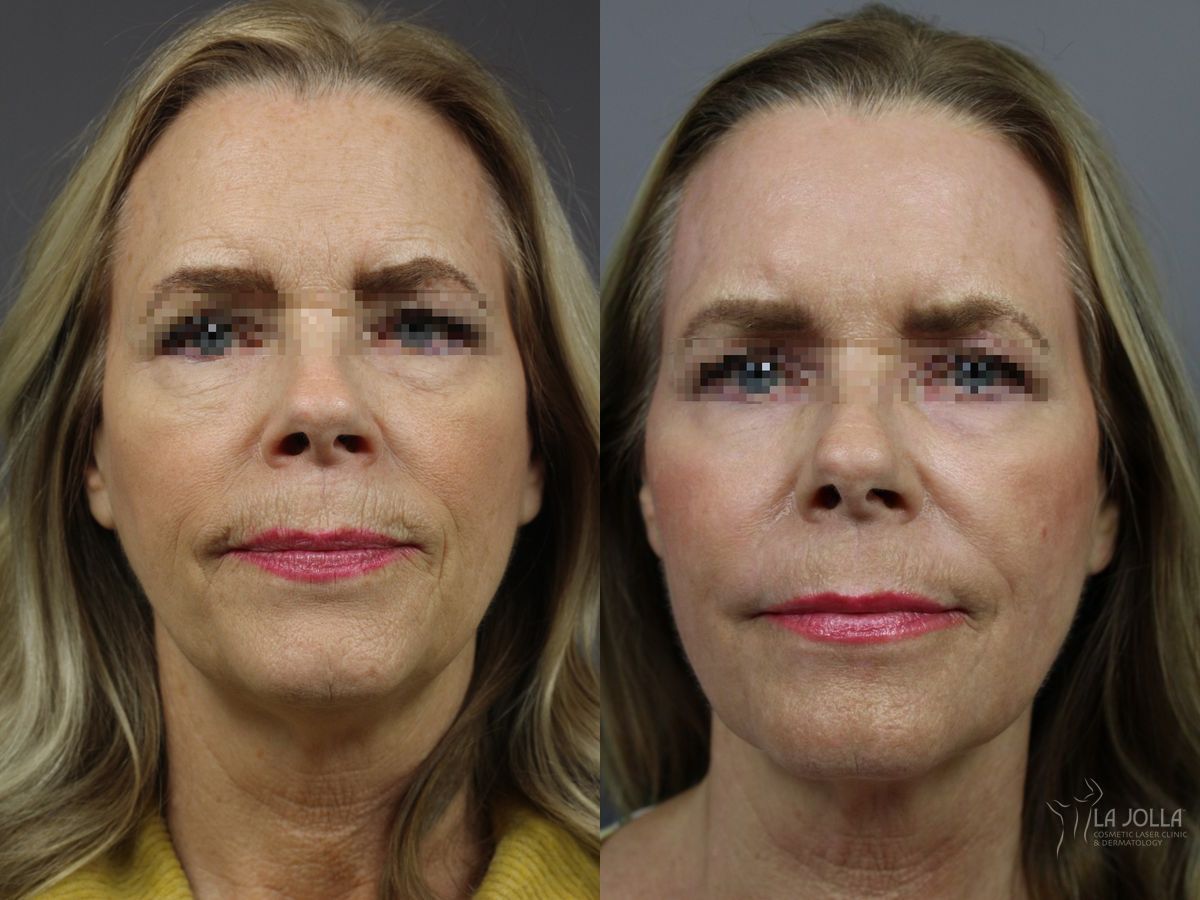 Before and after Ablative Laser Treatment case 36333