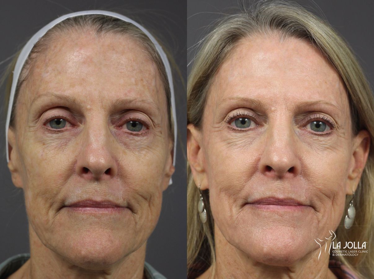 Before and after Ablative Laser Treatment case 36342