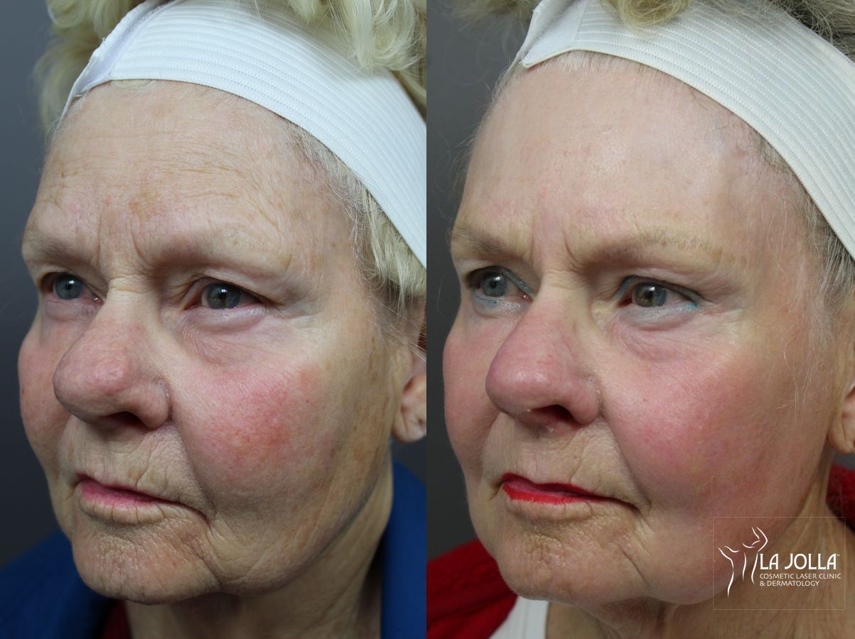 Before and after Ablative Laser Treatment case 36319