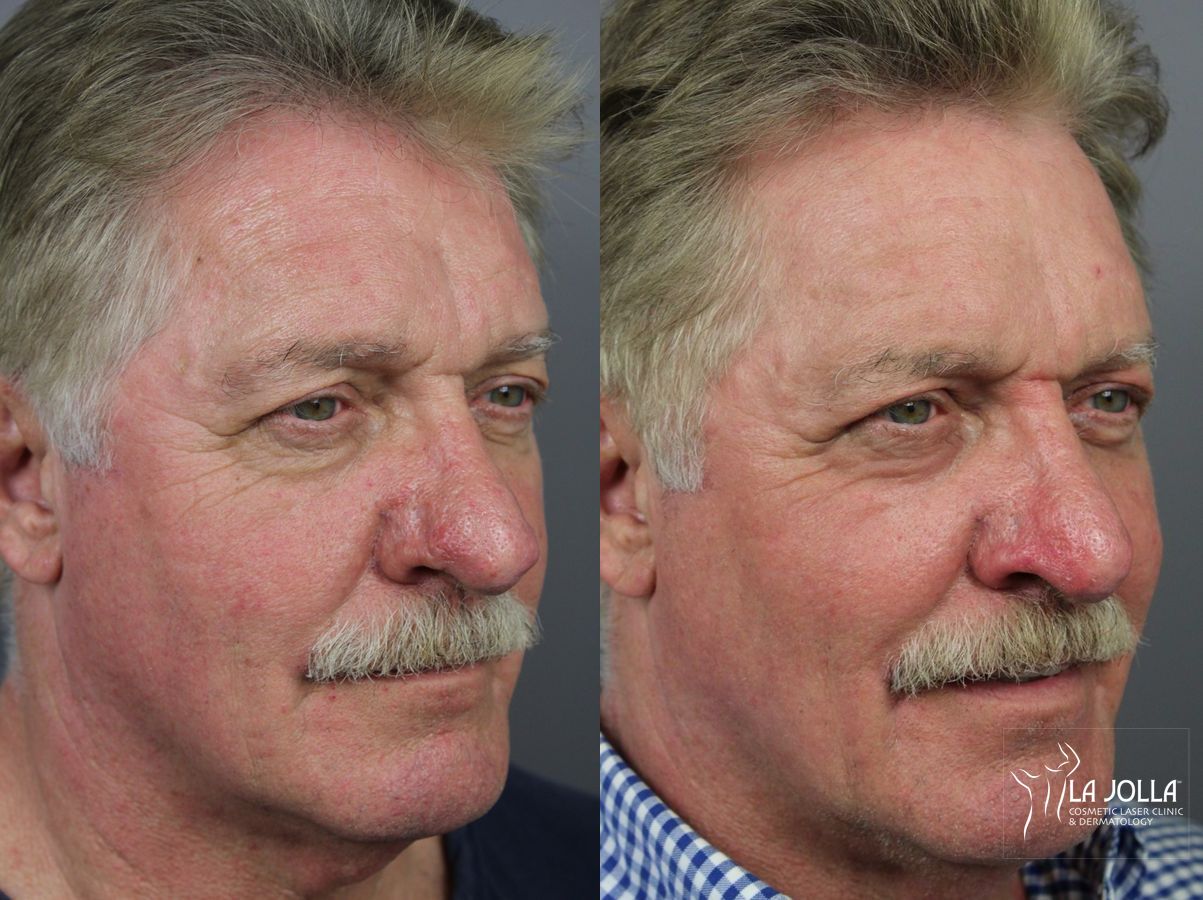 Before and after Ablative Laser Treatment case 36322 - Angle 3
