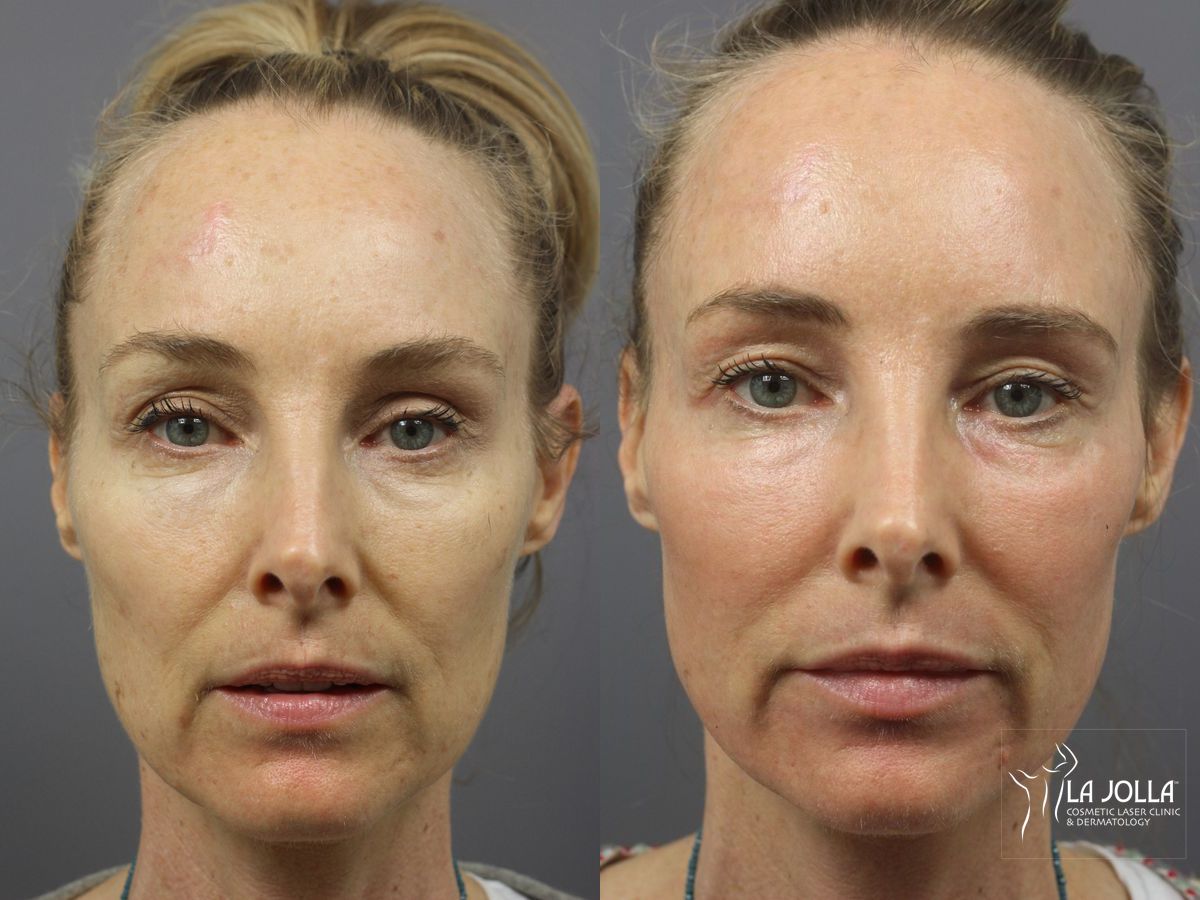 Before and after Ablative Laser Treatment case 36344