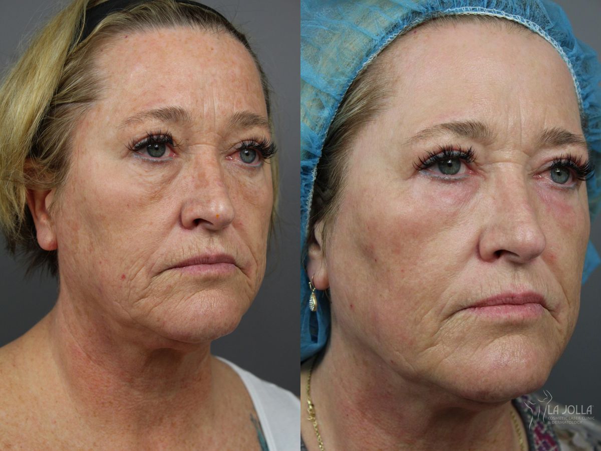 Before and after Ablative Laser Treatment case 36364 - Angle 2