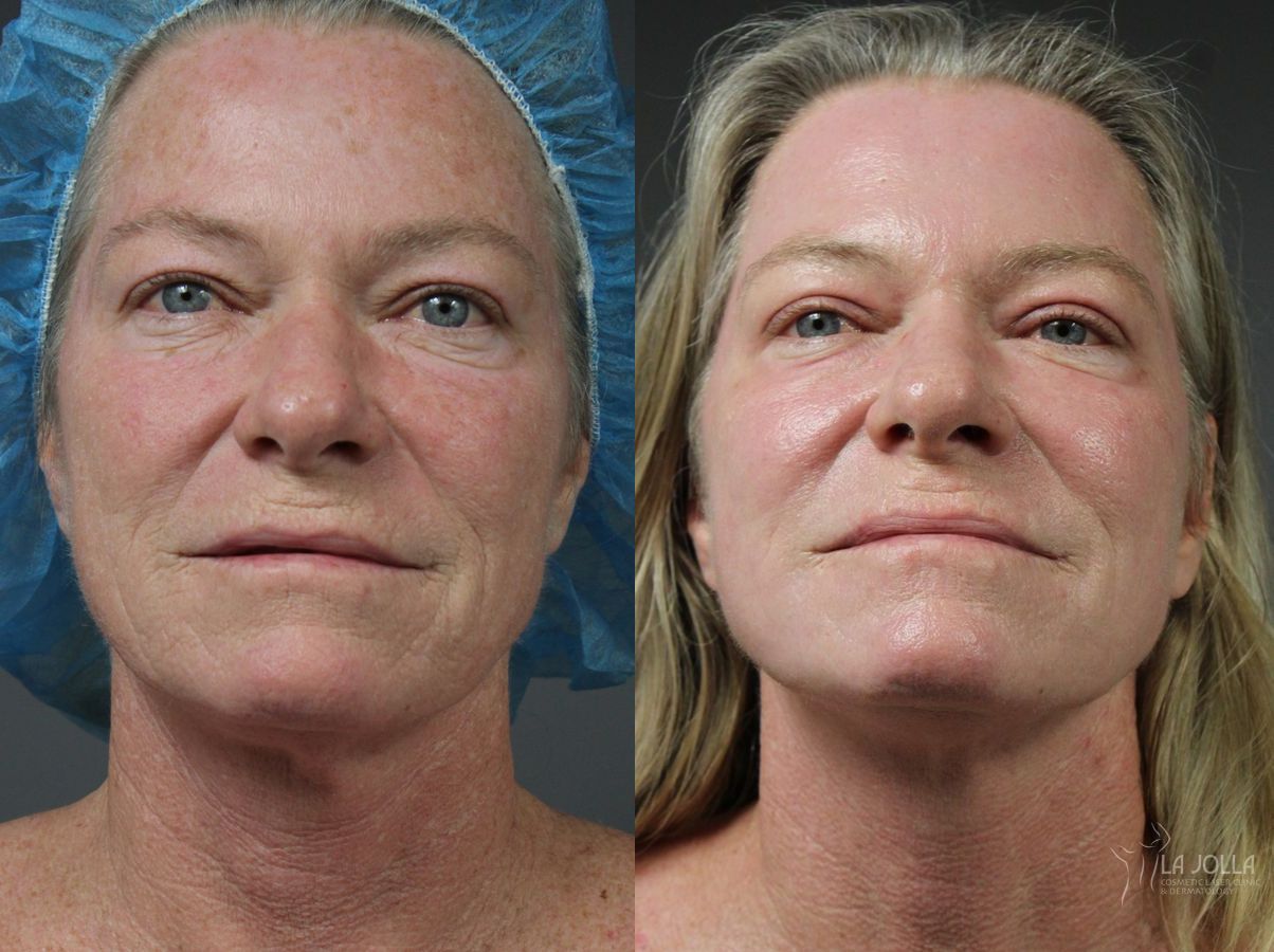 Before and after Ablative Laser Treatment case 36083