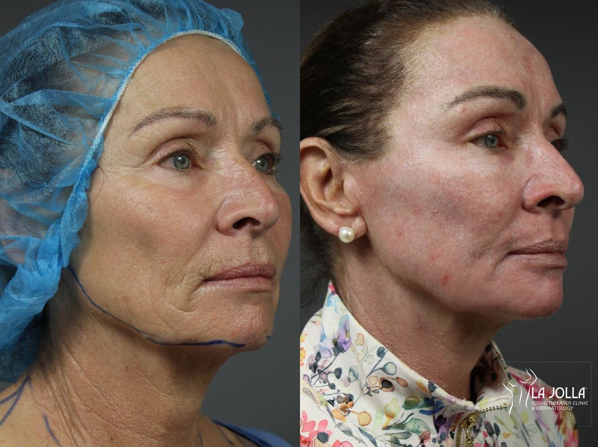 Before and after Ablative Laser Treatment case 36120 - Angle 3
