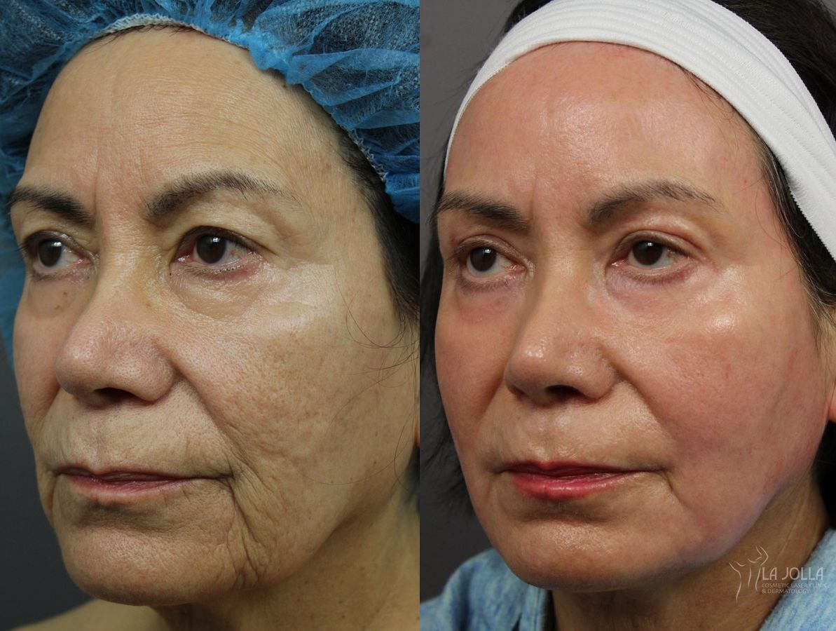 Before and after Ablative Laser Treatment case 36302 - Angle 2