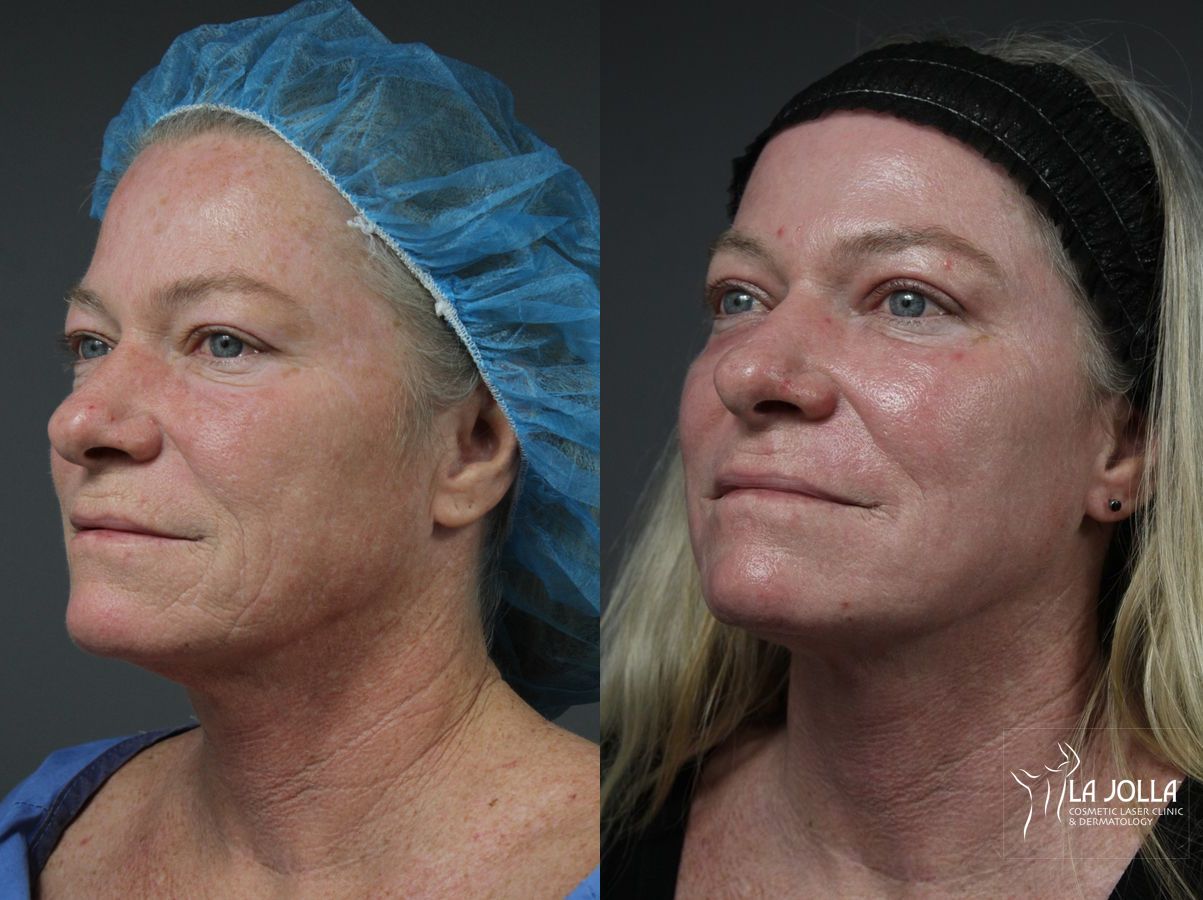 Before and after Ablative Laser Treatment case 36163 - Angle 2