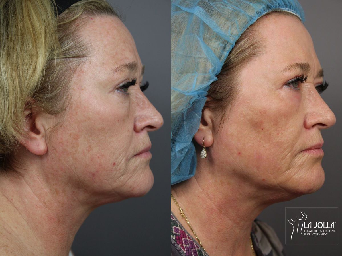 Before and after Ablative Laser Treatment case 36364 - Angle 3