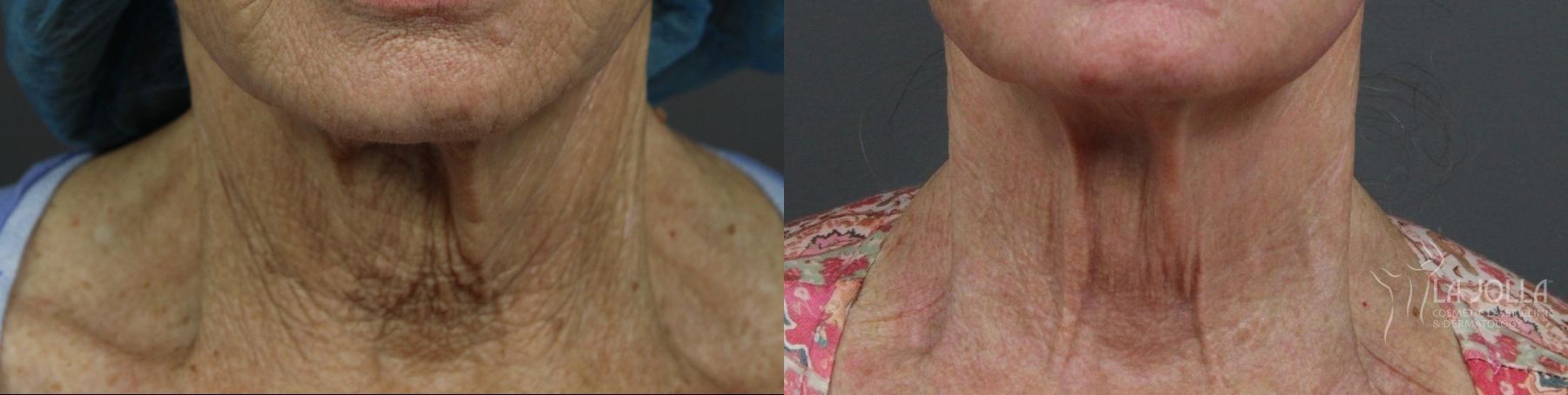 Before and after Ablative Laser Treatment case 36223 - Angle 4