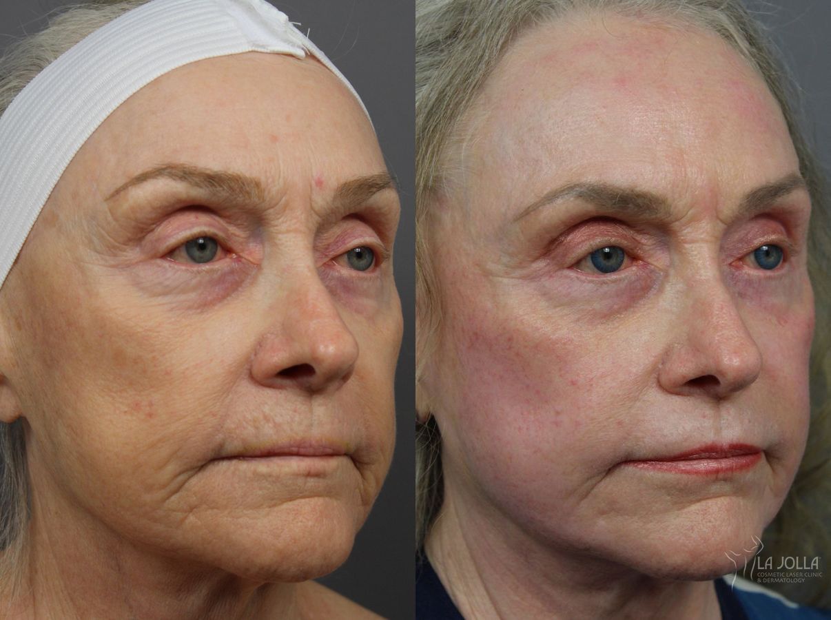 Before and after Ablative Laser Treatment case 36318