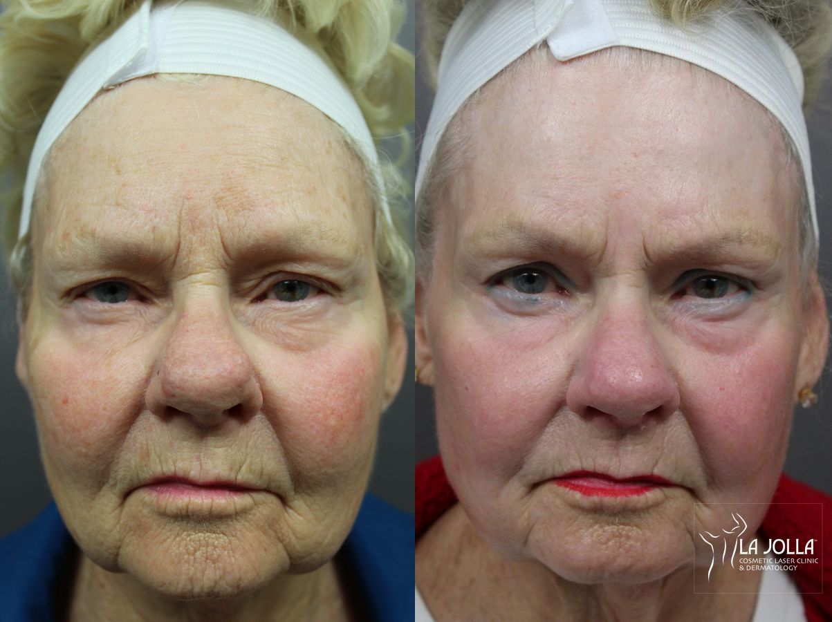 Before and after Ablative Laser Treatment case 36319 - Angle 3