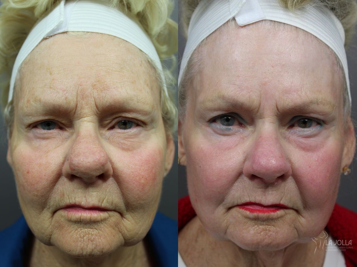 Before and after Ablative Laser Treatment case 36319 - Angle 3