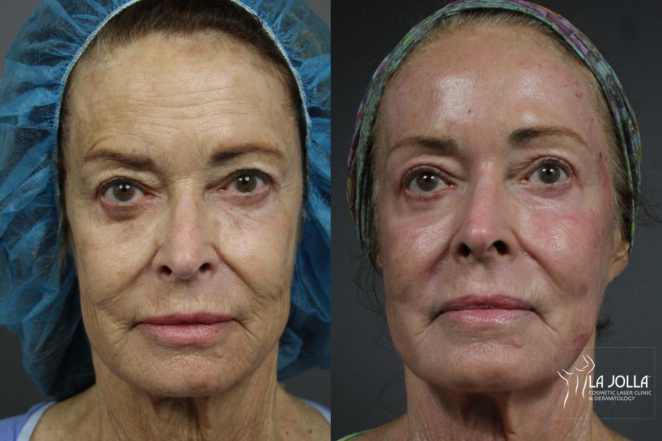 Before and after Ablative Laser Treatment case 36223