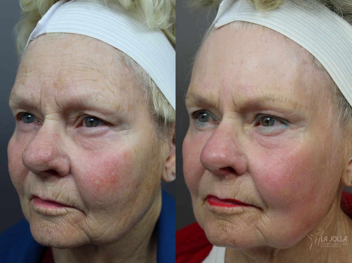 Before and after Ablative Laser Treatment case 36319