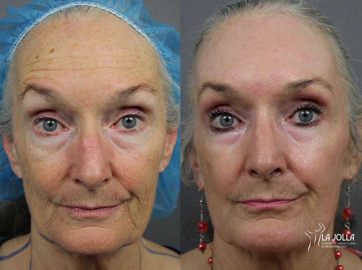 Before and after Ablative Laser Treatment case 36324