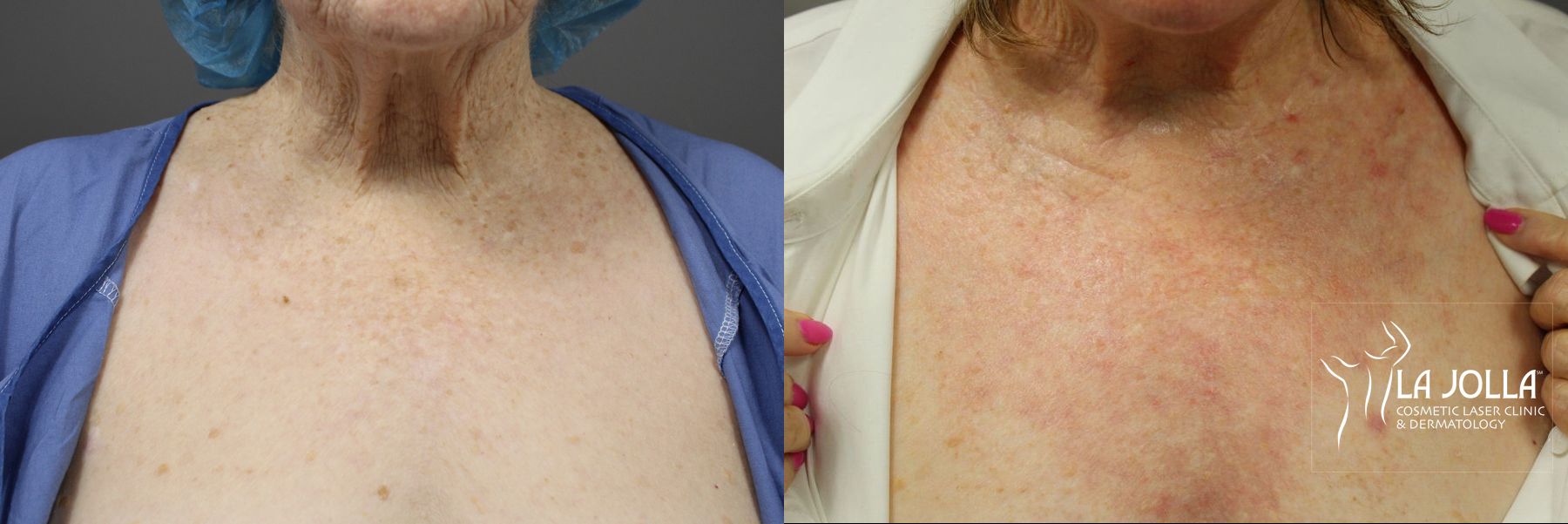 Before and after Ablative Laser Treatment case 36143 - Angle 4