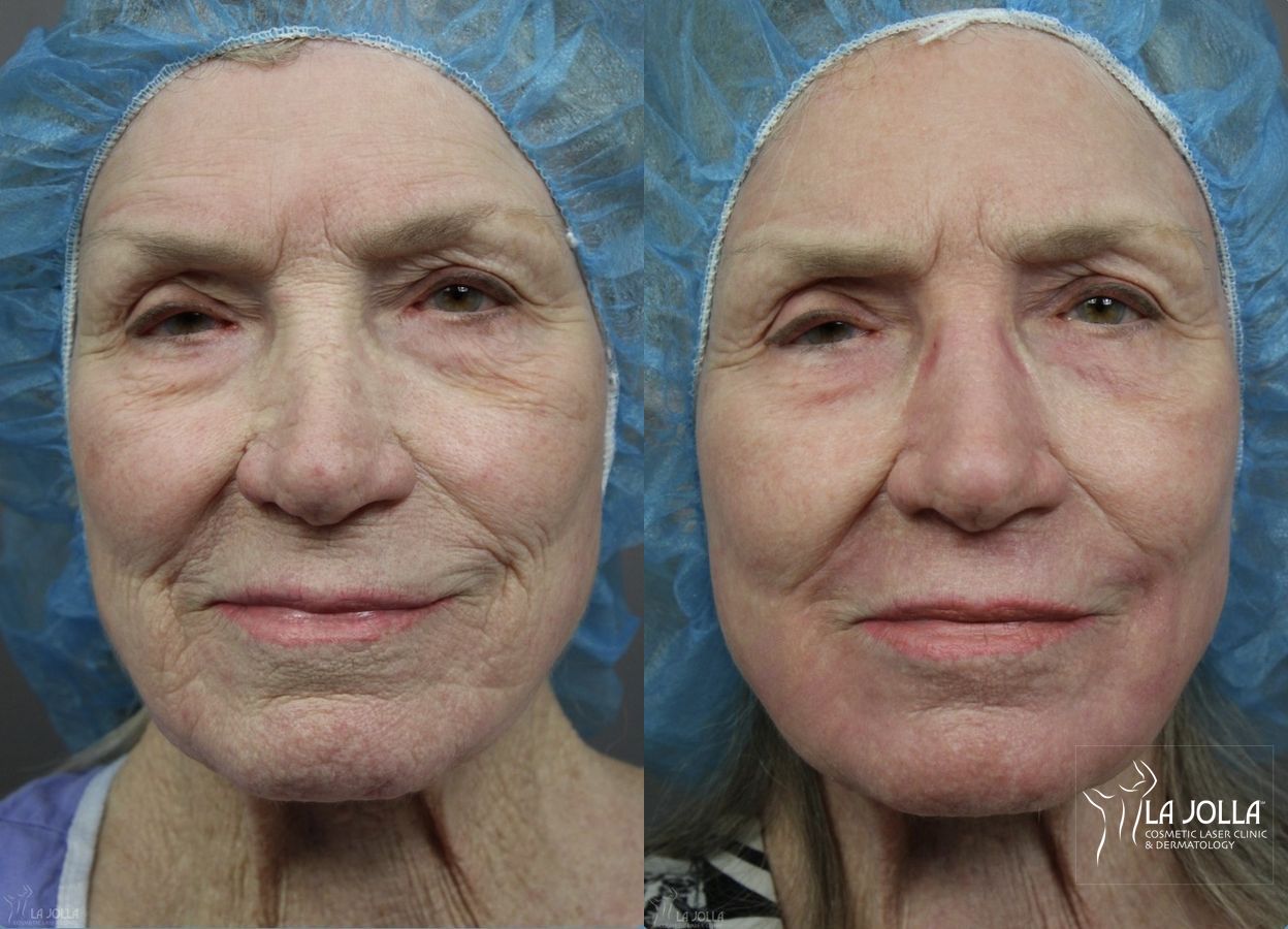 Before and after Ablative Laser Treatment case 36254