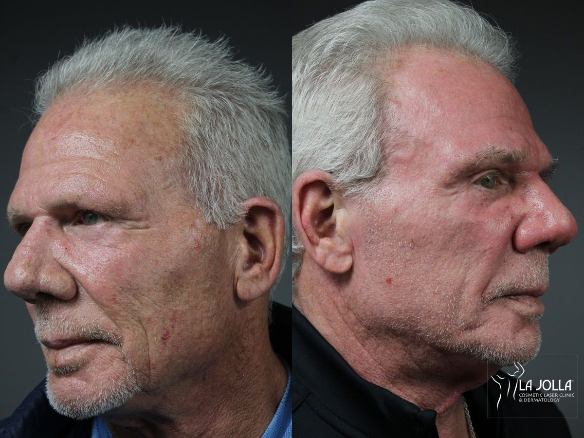 Before and after Ablative Laser Treatment case 36100 - Angle 3