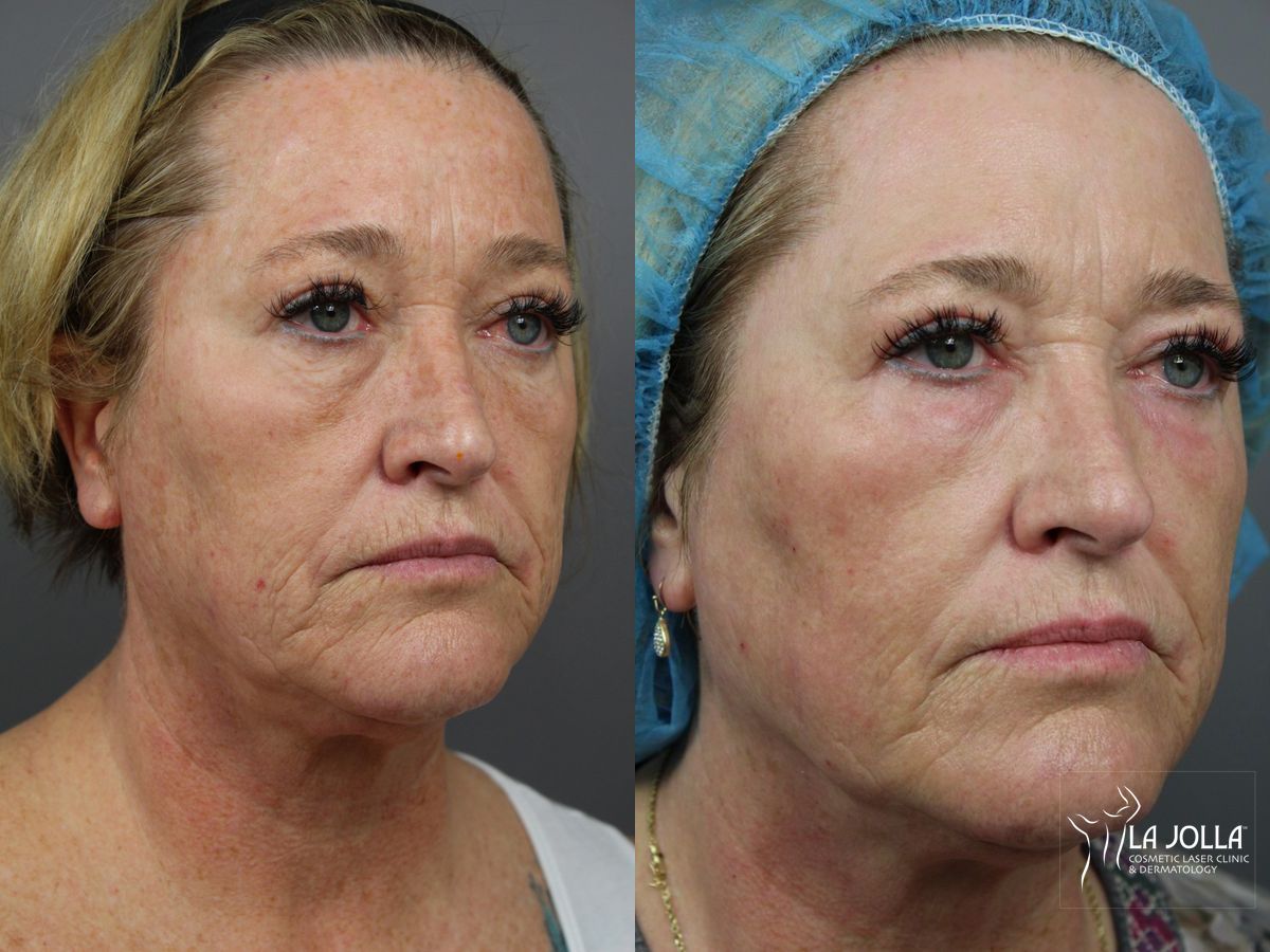 Before and after Ablative Laser Treatment case 36364 - Angle 2