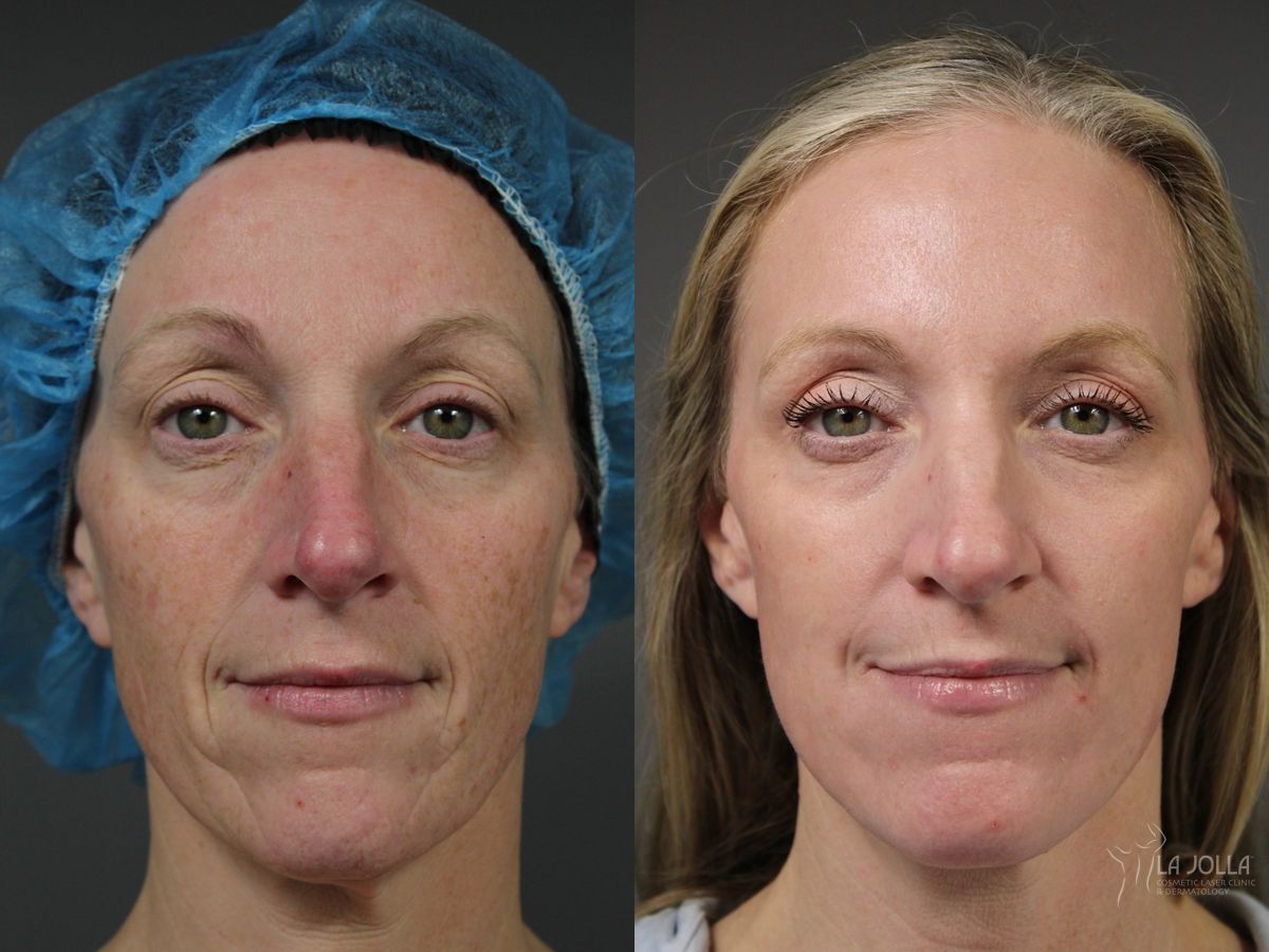 Before and after Ablative Laser Treatment case 41767