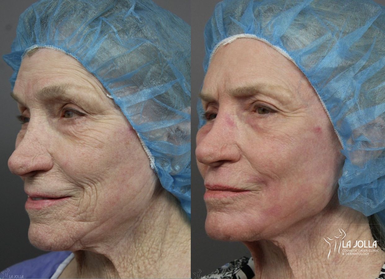Before and after Ablative Laser Treatment case 36254 - Angle 2