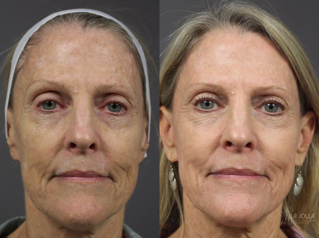 Before and after Ablative Laser Treatment case 36342