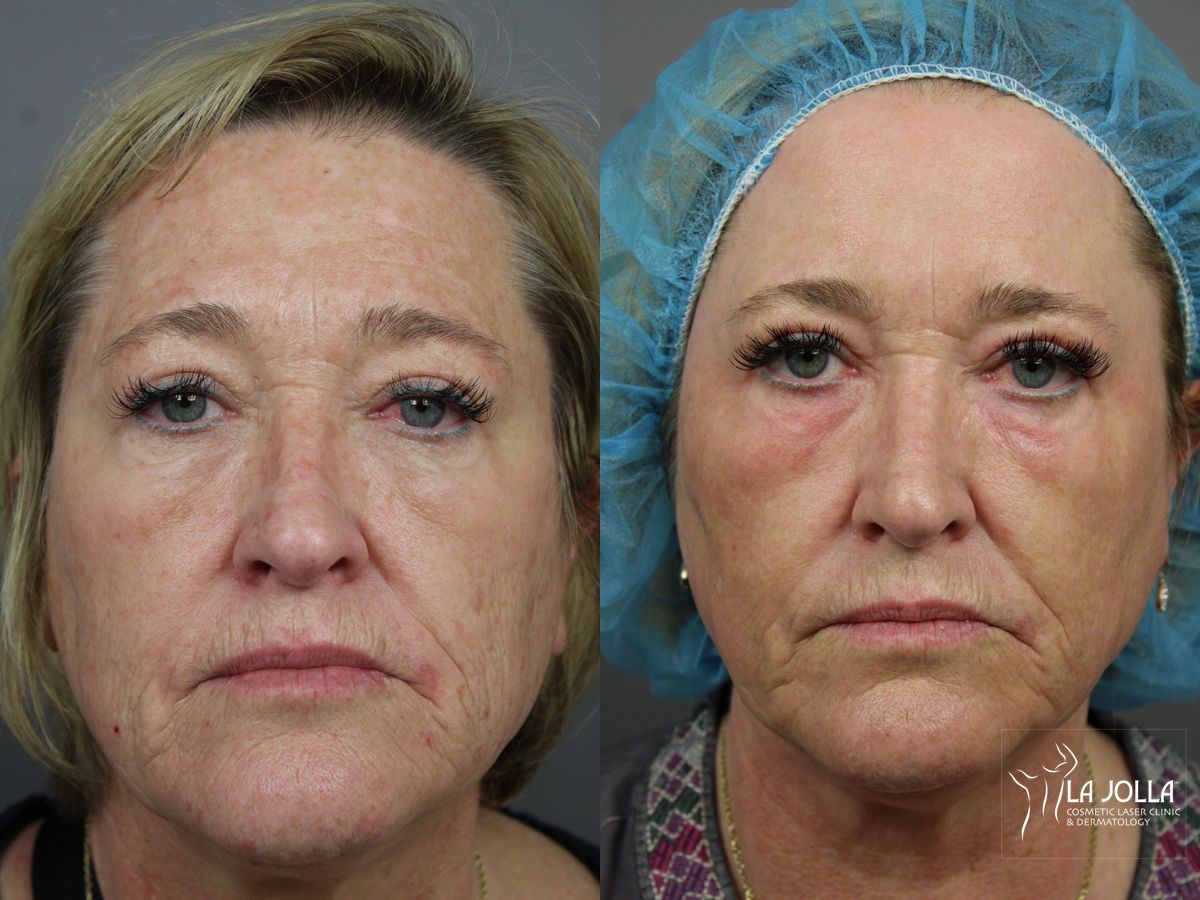 Before and after Ablative Laser Treatment case 36364