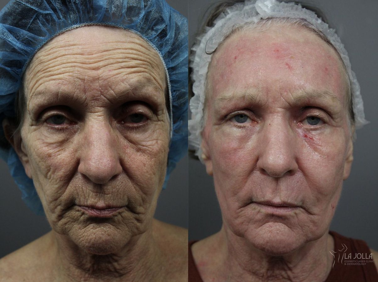 Before and after Ablative Laser Treatment case 36188