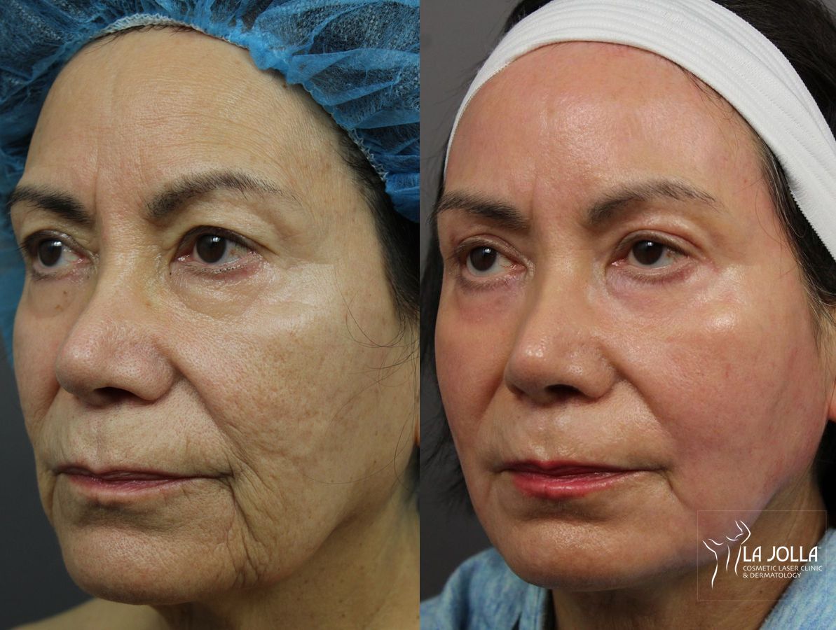 Before and after Ablative Laser Treatment case 36302 - Angle 2