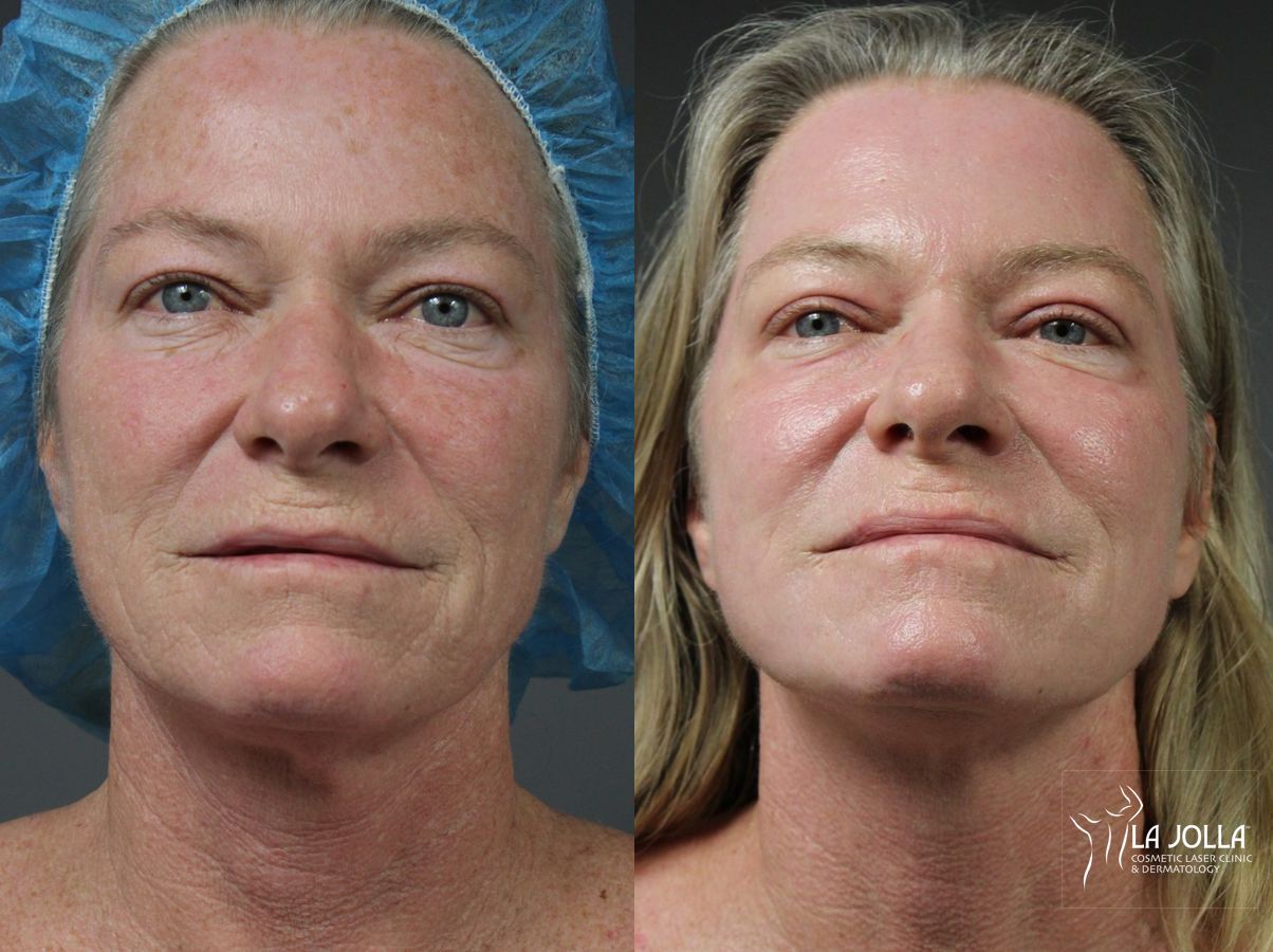 Before and after Ablative Laser Treatment case 36083