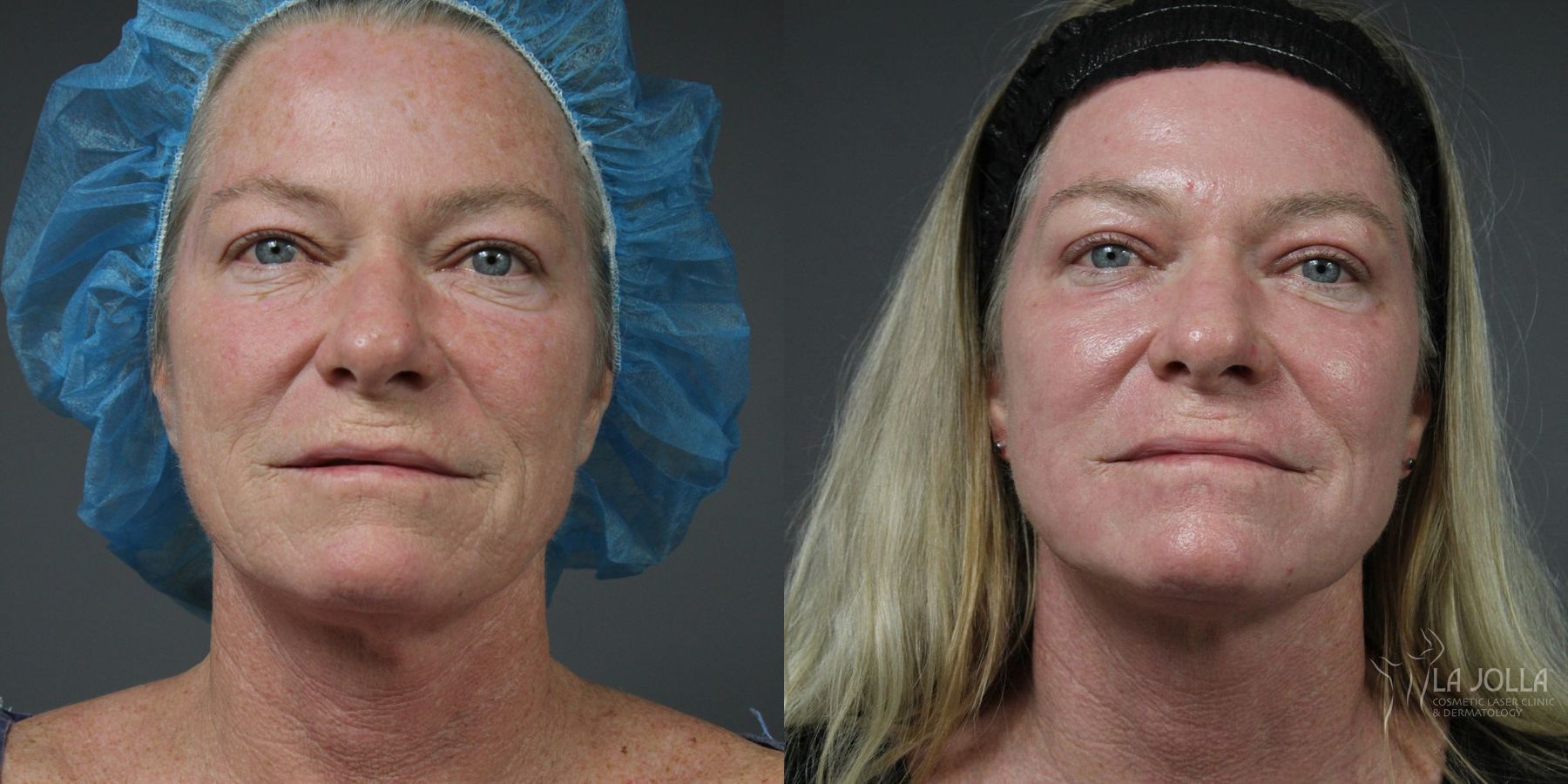 Before and after Ablative Laser Treatment case 36163