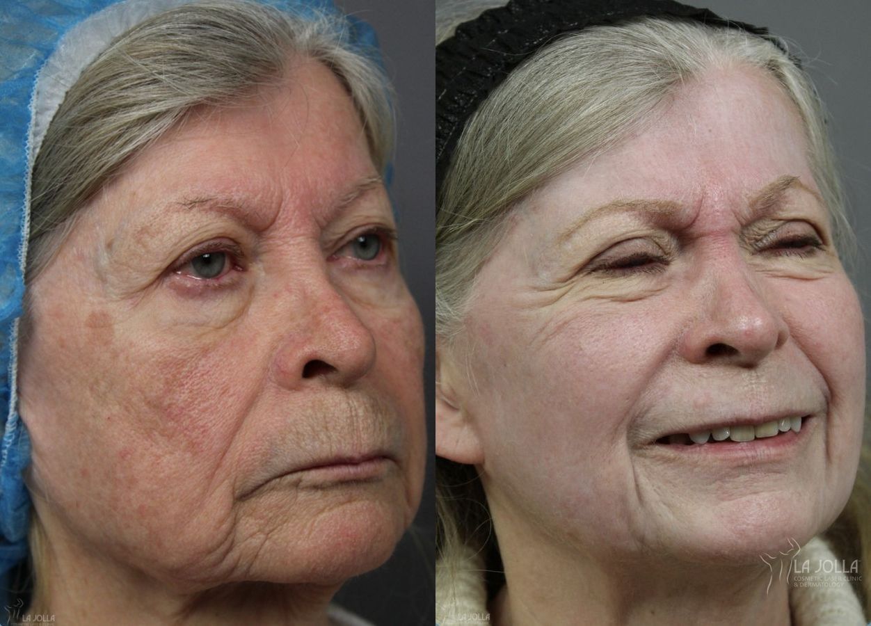 Before and after Ablative Laser Treatment case 36253 - Angle 3
