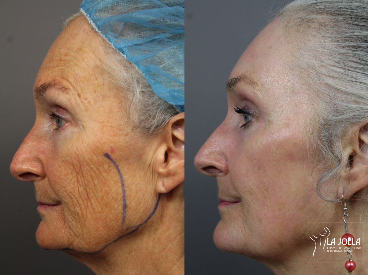 Before and after Ablative Laser Treatment case 36324 - Angle 3
