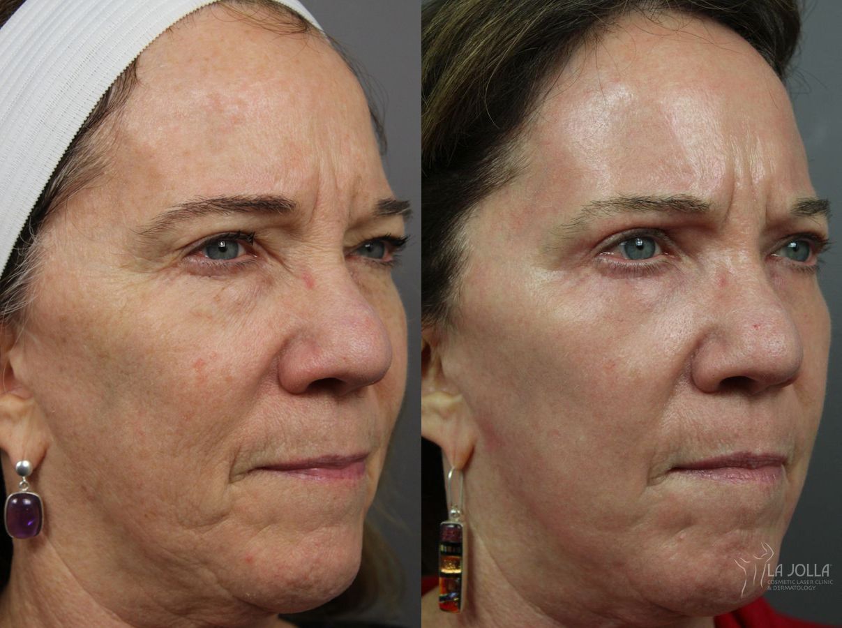 Before and after Ablative Laser Treatment case 36304 - Angle 3