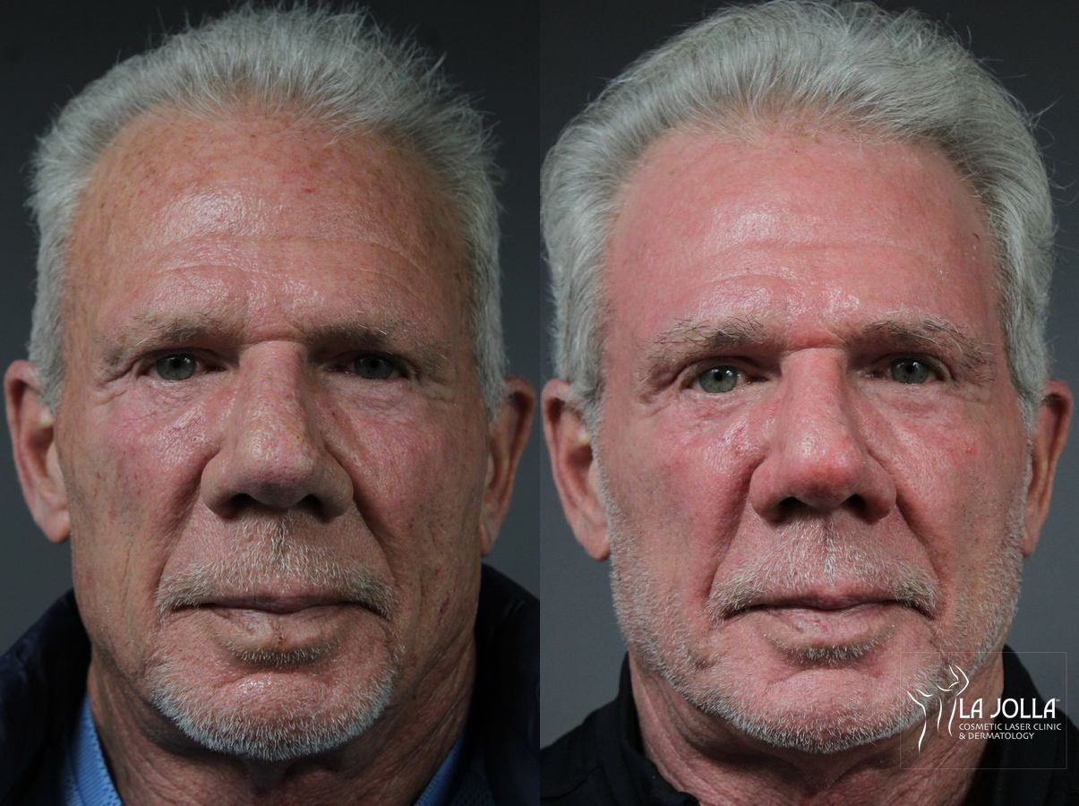 Before and after Ablative Laser Treatment case 36100