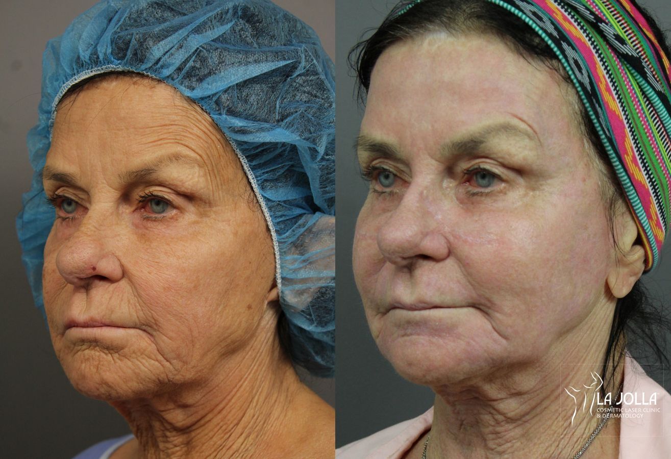 Before and after Ablative Laser Treatment case 36263 - Angle 3