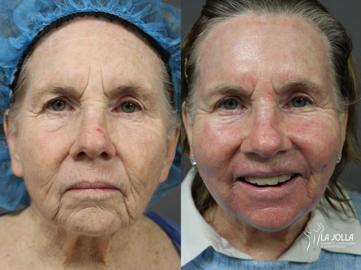 Before and after Ablative Laser Treatment case 36143