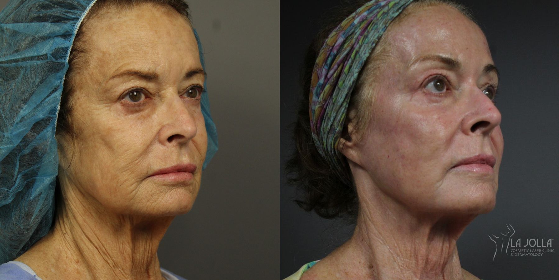 Before and after Ablative Laser Treatment case 36223 - Angle 2