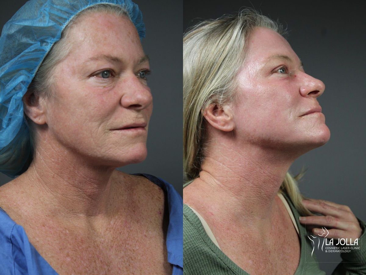 Before and after Ablative Laser Treatment case 36083 - Angle 2