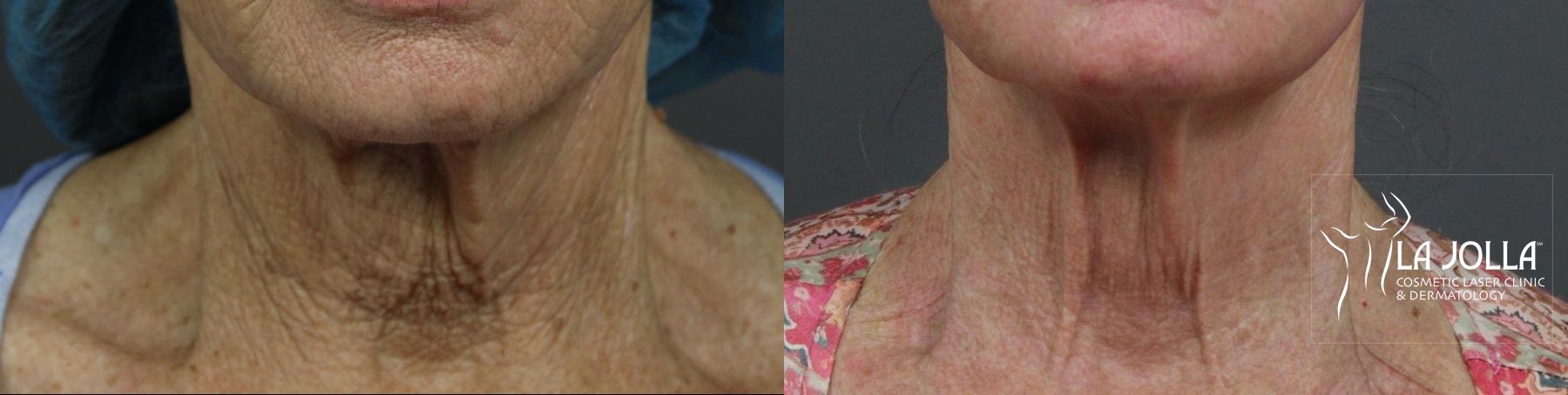 Before and after Ablative Laser Treatment case 36223 - Angle 4