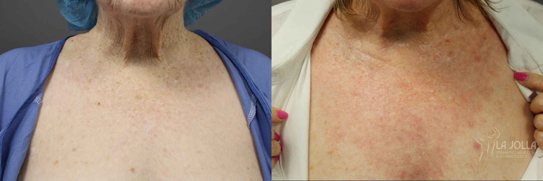 Before and after Ablative Laser Treatment case 36143 - Angle 4