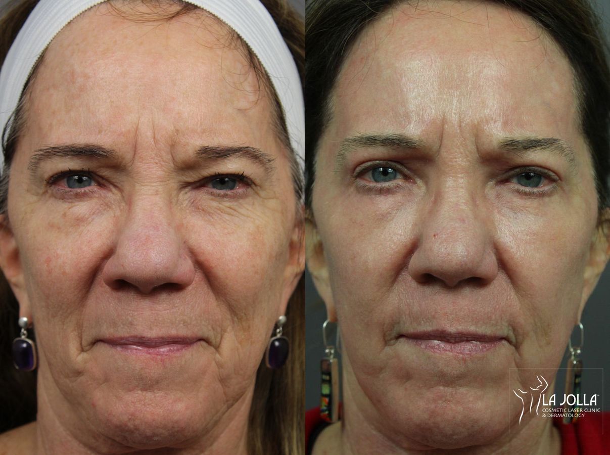 Before and after Ablative Laser Treatment case 36304 - Angle 2