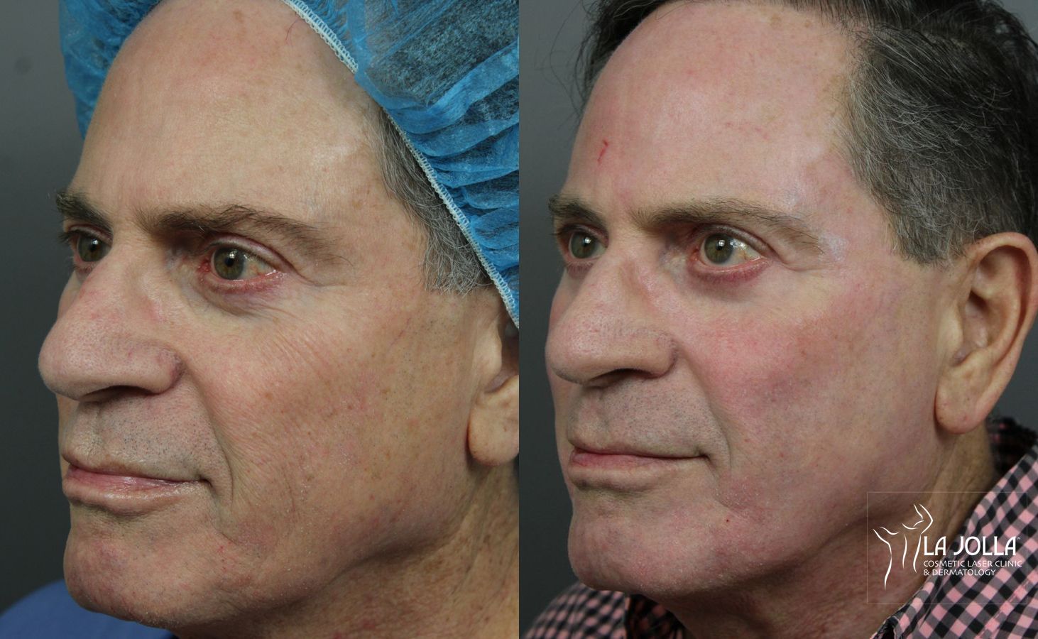 Before and after Ablative Laser Treatment case 36243 - Angle 3