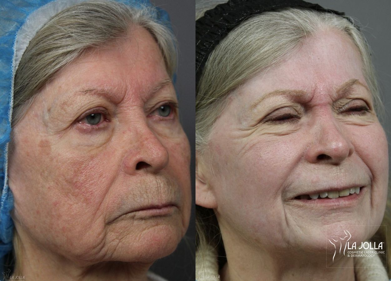 Before and after Ablative Laser Treatment case 36253 - Angle 3