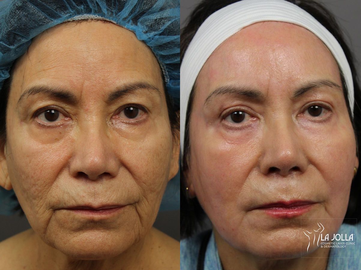 Before and after Ablative Laser Treatment case 36302 - Angle 3