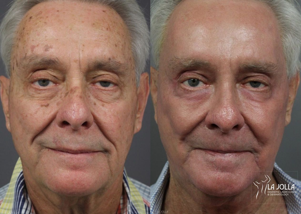 Before and after Ablative Laser Treatment case 36279