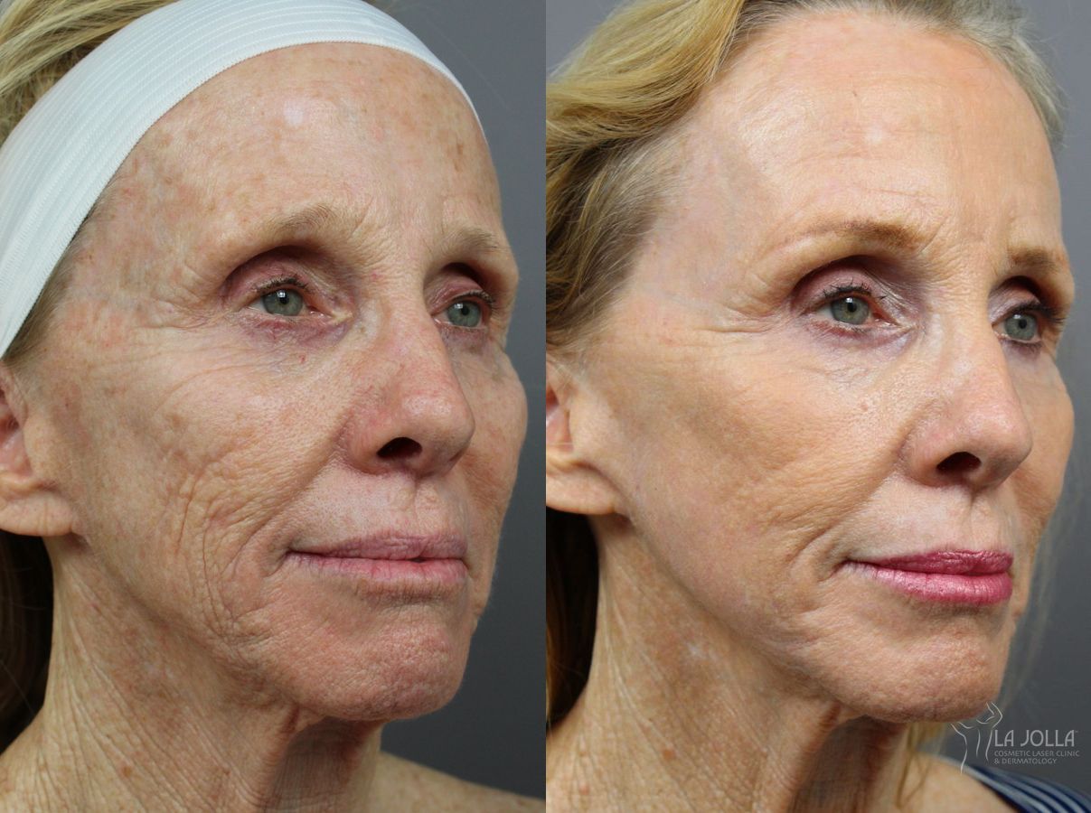 Before and after Ablative Laser Treatment case 36329