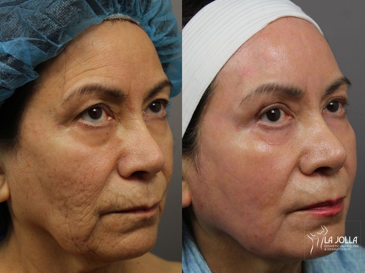 Before and after Ablative Laser Treatment case 36302