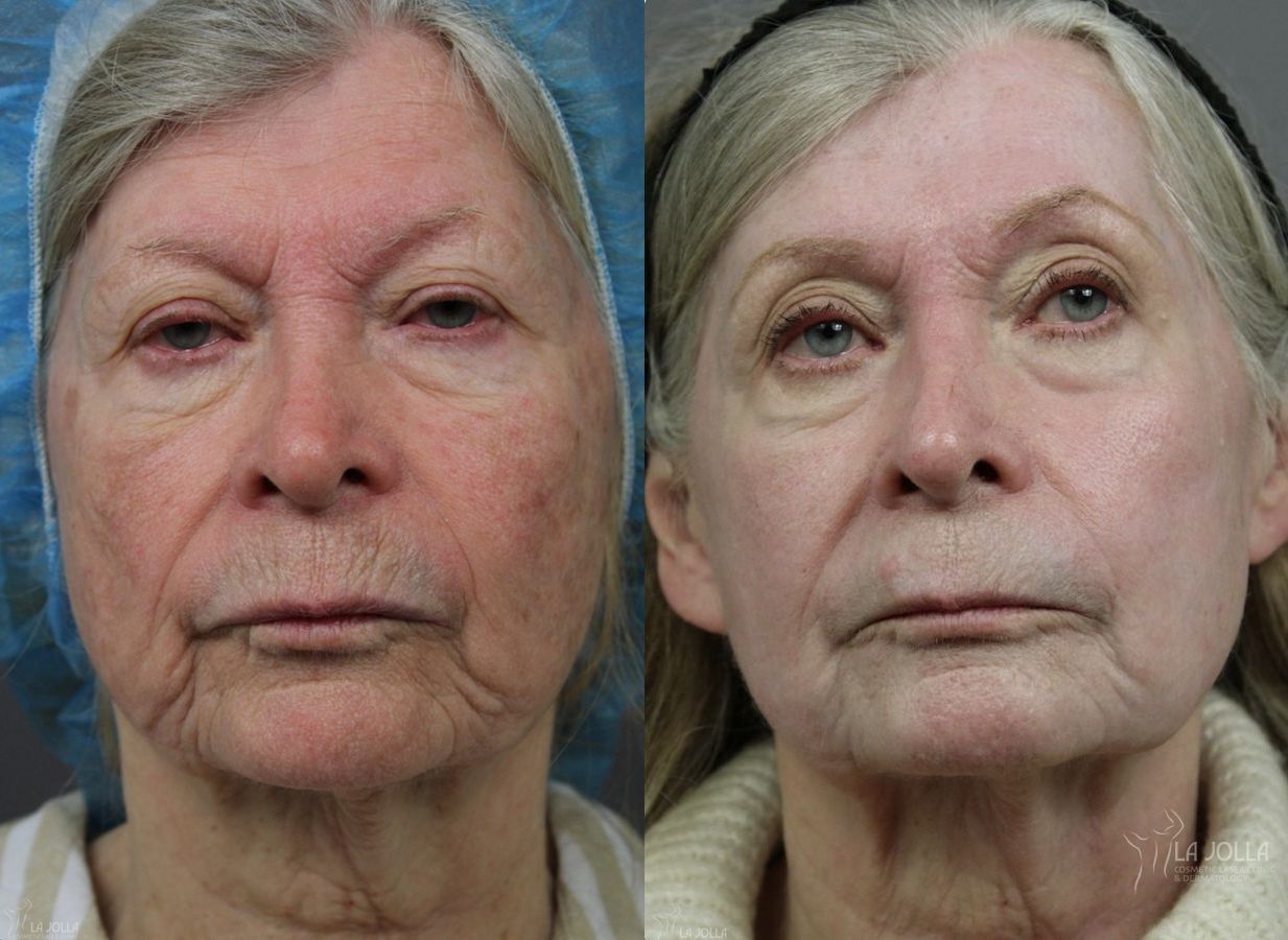 Before and after Ablative Laser Treatment case 36253